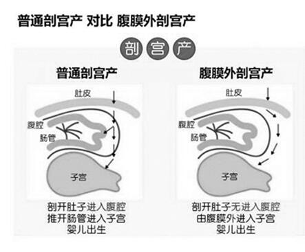 杭州艾玛妇产医院开展腹膜外剖宫产手术