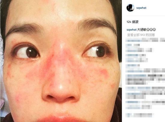 39岁舒淇脸部出现大片红疹疑因劳累过度导致过敏